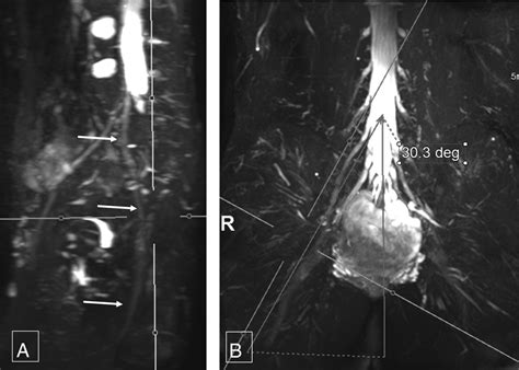 3D MR Neurography of the Lumbosacral Plexus: Obtaining Optimal Images for Selective Longitudinal ...