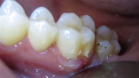 Bildergebnis für abscess tooth popped in mouth