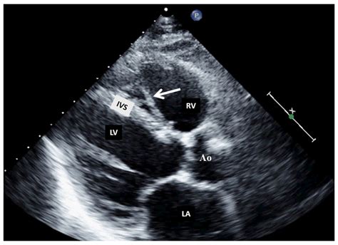 Multimodality Imaging in Right Heart Tumors: Proposed Algorithm towards an Appropriate Diagnosis