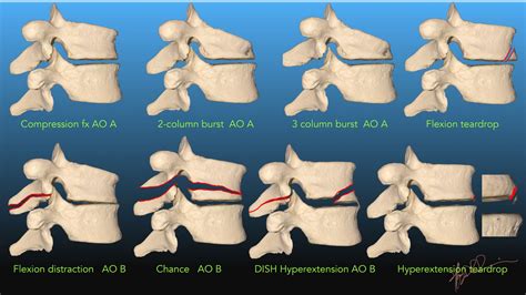 Unstable spinal fracture definition, Pelvic Fractures