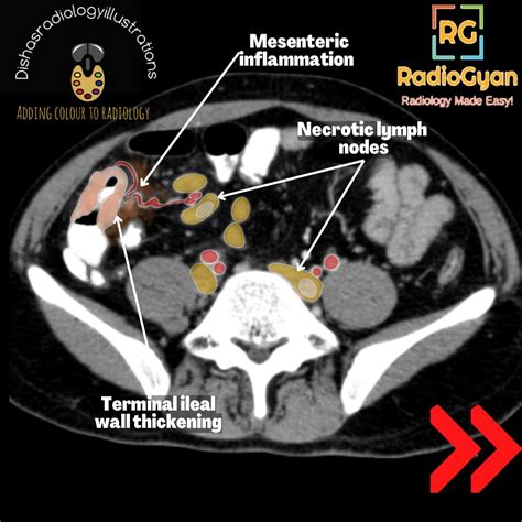 Ileocecal tuberculosis | Radiology Case