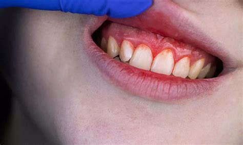 Link Between Periodontitis and AMD: A Modifiable Risk Factor: Study