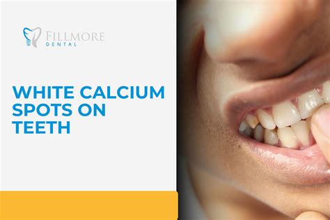 Image result for Bottom Teeth Calcium Buildup