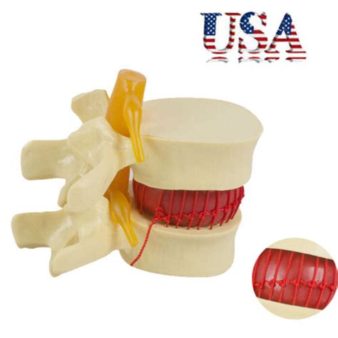 Anatomical Spine Lumbar Disc Herniation Anatomy | Ubuy India