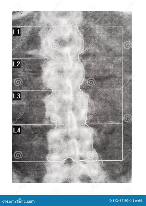 Bone Density DEXA Scan. Osteoporosis Diagnosis. Stock Illustration - Illustration of fracture ...