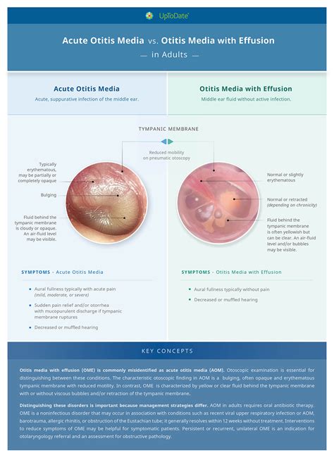 Normal Tympanic Membrane Vs Otitis Media at Carmen Decker blog