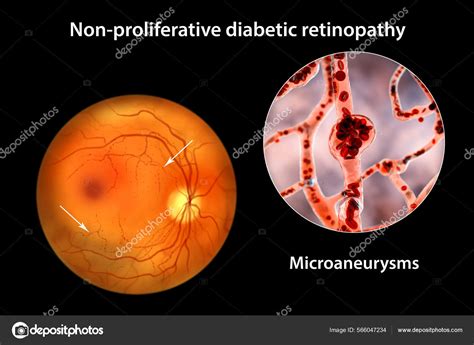 Non Proliferative Diabetic Retinopathy Illustration Showing Multiple ...