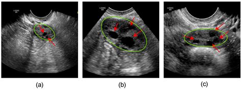 Normal Ovary Sonography
