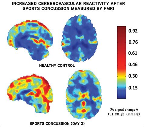 Concussions (Mild Traumatic Brain Injury) - Knee & Sports - Orthobullets
