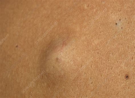 Image result for Sebaceous Cyst On Back