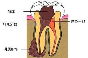 牙髓炎的症状与分类有哪些-海南口腔医院【官网】