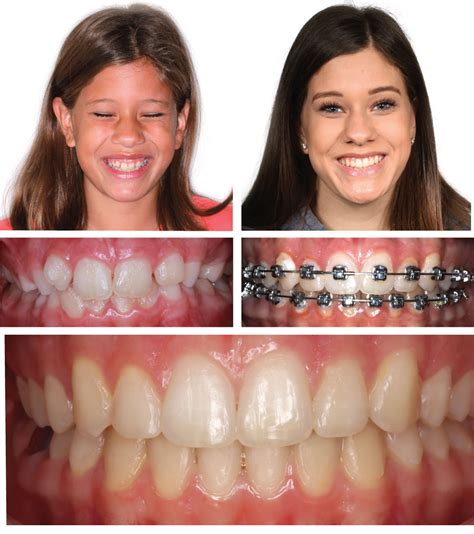Damon Braces