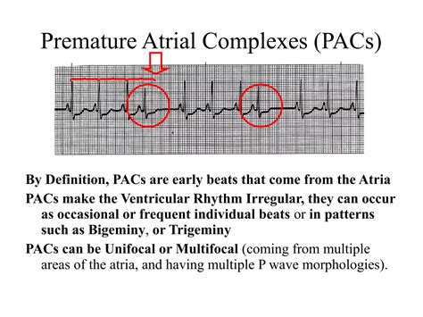 Atrial Premature Complex
