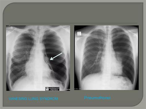Bullous disease of lung.pptx
