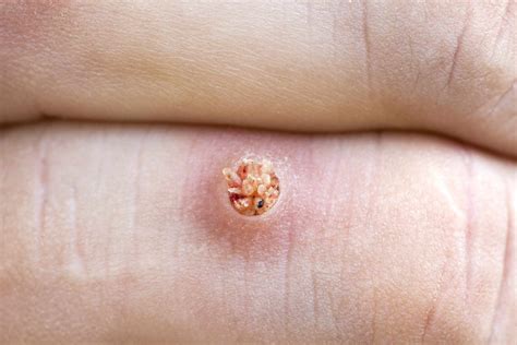 Warts: Types, Symptoms, Causes, Treatment, and More