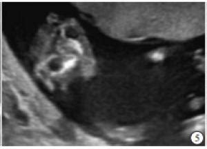 超声筛查孕11~13 +6 周胎儿畸形的临床应用