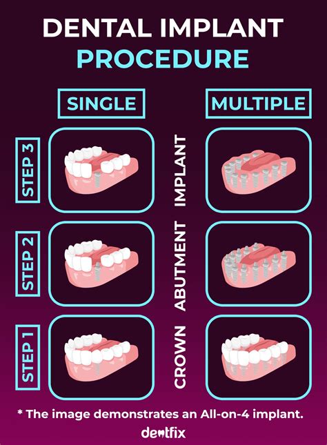 Dental Implant Procedure: Step-by-Step into Sessions - Dentfix