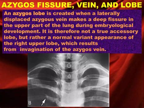 Azygos fissure, vein, and lobe | PPTX