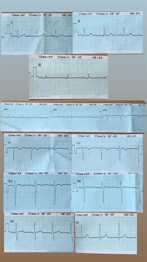 58/F with CAD and CKD V (secondary to Hypertensive Nephrosclerosis) on ...