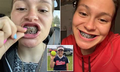 Softball player has her mouth wired SHUT after breaking her jaw ...