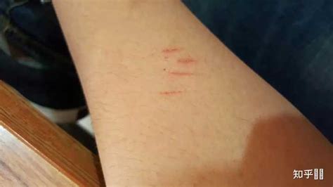 被猫狗抓伤了，为什么要用肥皂水冲洗伤口？_疫苗