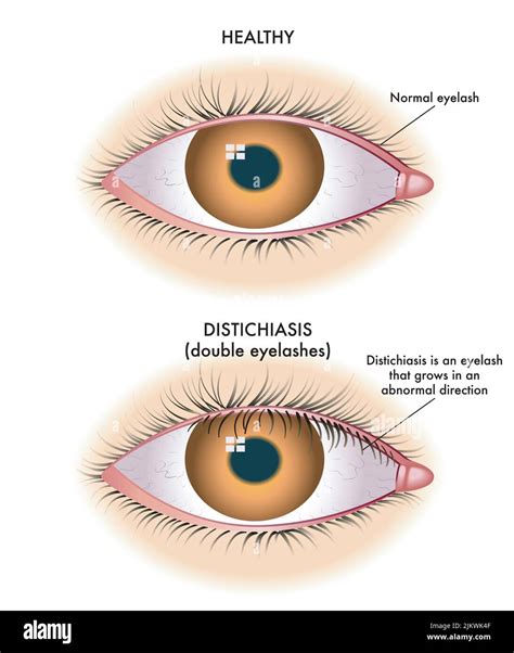 Medical illustration shows the comparison between a normal eye and one ...