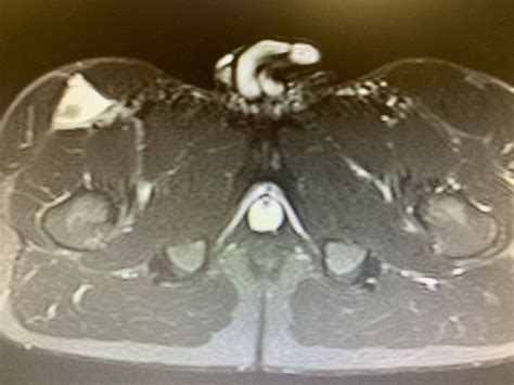 Rectus femoris injury information - Urheiluortopedi Lasse Lempainen