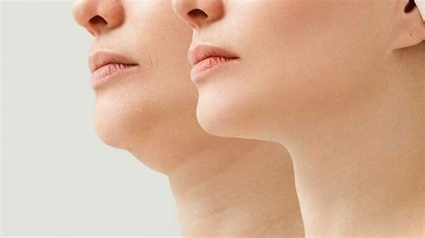 Image result for Chin Botox