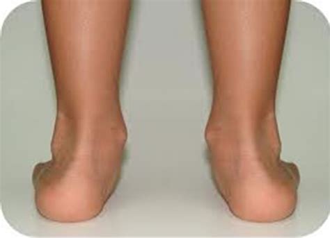 Normal Variants of the Lower Limbs in Pediatric Orthopedics