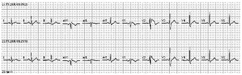 Right Bundle Branch Block or Brugada Syndrome?