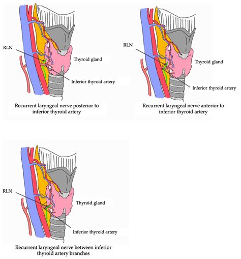Inferior Laryngeal Artery Gallery | Vicky Earle – Medical Illustration