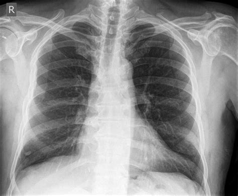Nodules And Masses | Pulmonary Nodule X Ray – XNCUC