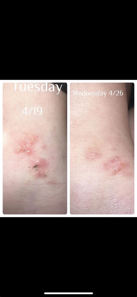 My 9 year old daughter keeps getting these bumps on her ankle. They seem to pop up, Sewell, scab ...