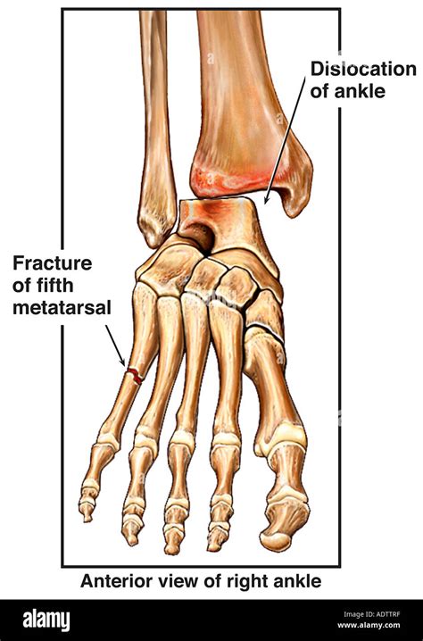 Types Of Broken Foot Bones at Larry Kirts blog