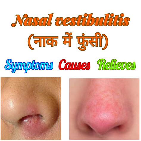 Understanding Nasal Vestibulitis – BLGQMG