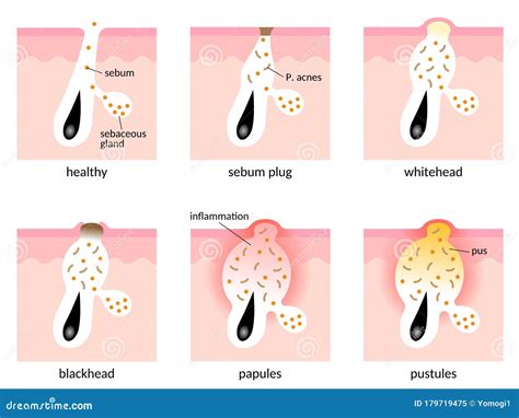 How Do Blackheads Form