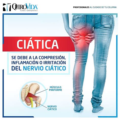 Nervio Ciatico Porque Duele