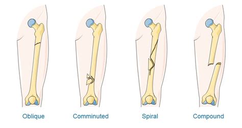 Image result for Open Fracture Surgery