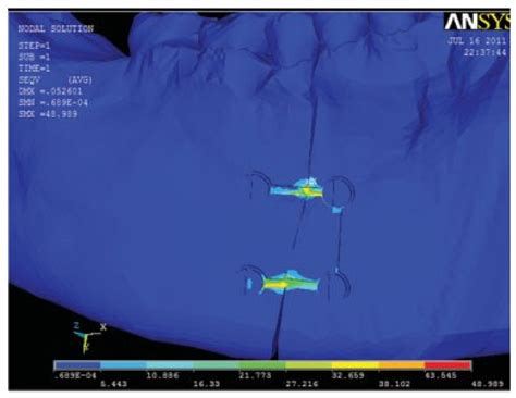 Finite Element Analysis Comparison of Plate Designs in Managing ...