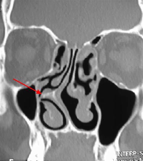 Septoplasty Surgery - Recovery Time & Complications