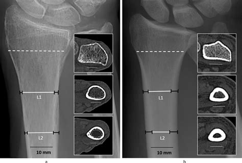 Cortical bone thickness of the distal radius predicts the local bone ...