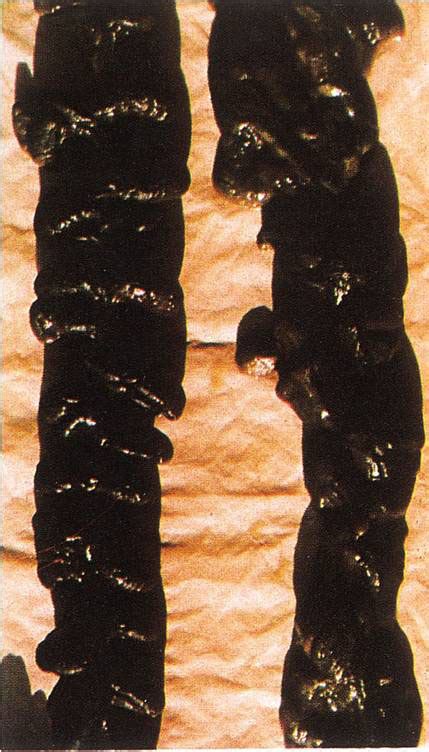 Color Of Stool With Colon Cancer - Infoupdate.org