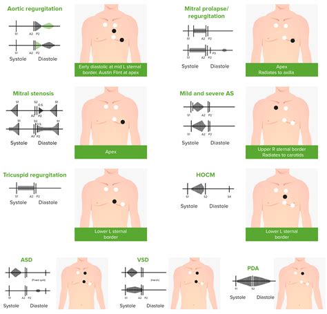 Mitral Regurgitation | Concise Medical Knowledge