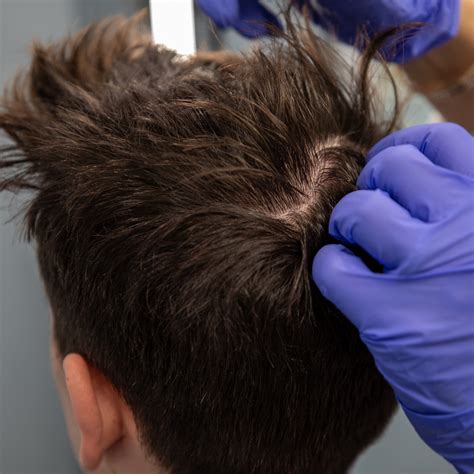PRP Hair Restoration | dr doris