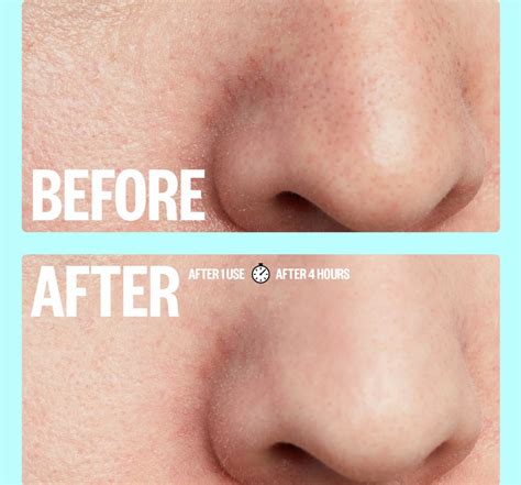 What Are The Strongest Pore Strips at Jessie Ramirez blog