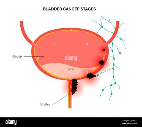 Bladder cancer stages, illustration Stock Photo - Alamy