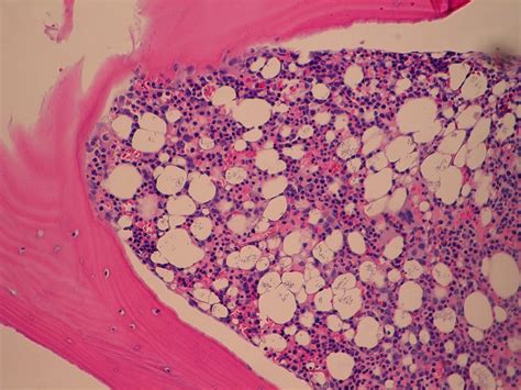 Demystifying the Bone Marrow Biopsy - What You Should Expect