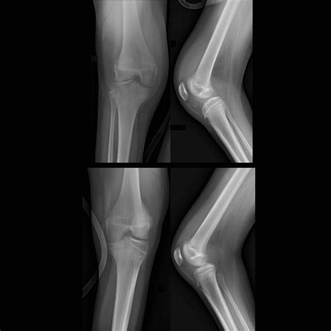 Pediatric Knee Joint Effusion | Pediatric Radiology Reference Article ...