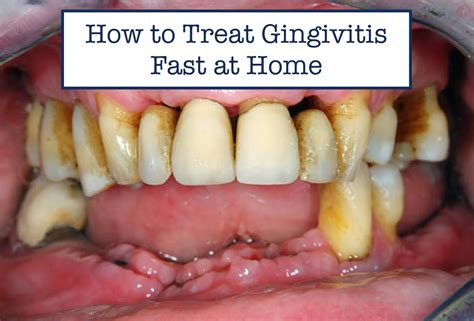Gingivitis Treatment At Home