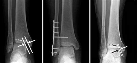 Lateral Malleolus Fracture - Healing Time, Treatment, ICD 9, Causes